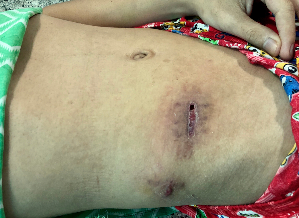 surgical dehiscence st augustine